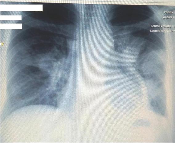 Chest X-ray after 7 days: a big oval cavity image of 13 cm in the left inferior lobe; previous lesions have grown.