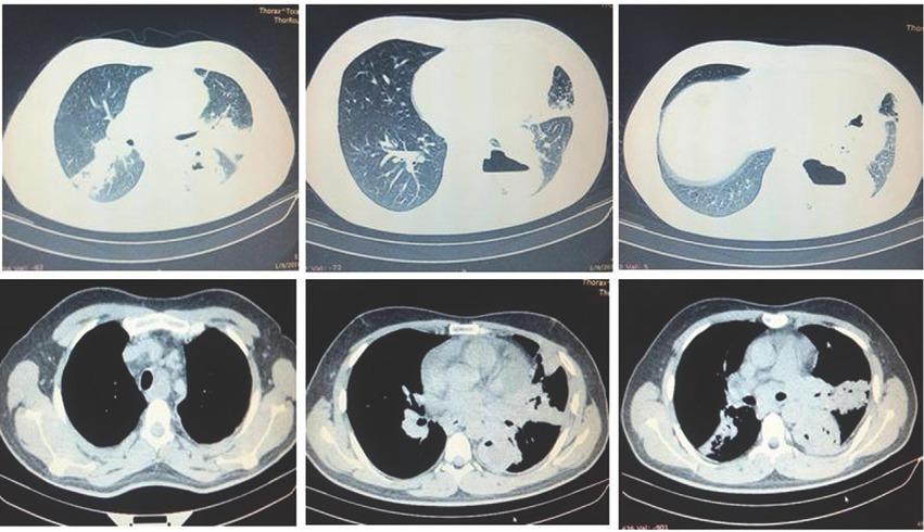 Multiple pulmonary consolidation areas located in left lung, and one consolidation area located in right lower lobe; multiple necrotizing lymphadenopathies in mediastinum.