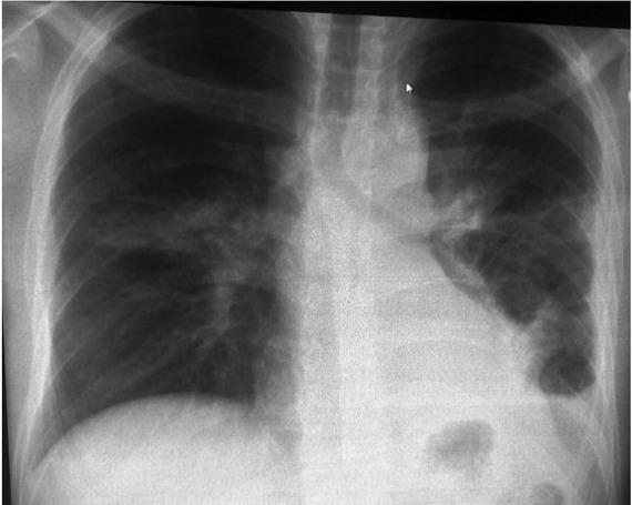 Chest X-ray after 12 months: a small cavity image of 2 cm in the left inferior lobe, laterothoracic and supradiaphragmatic sequelae.