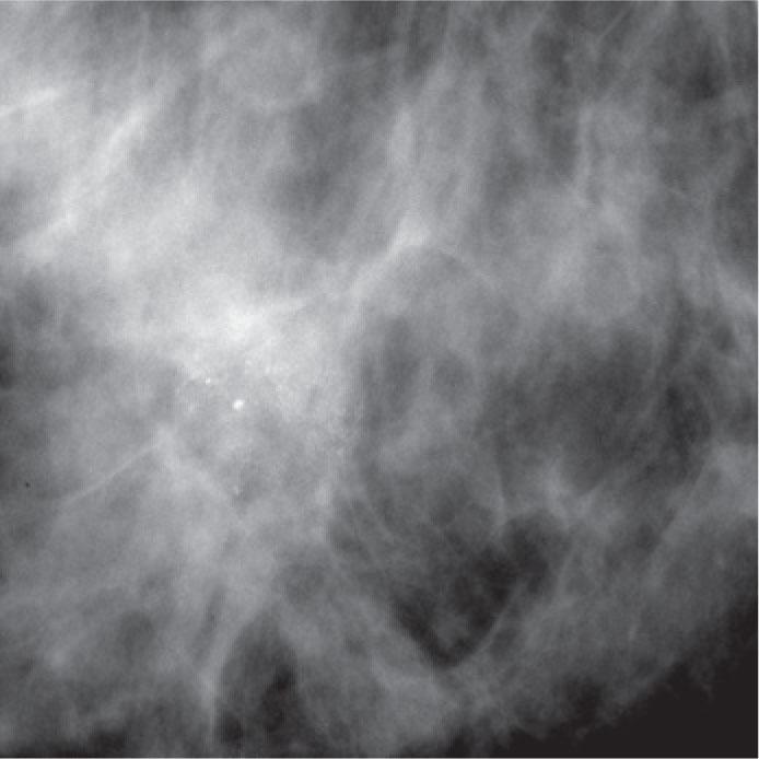 Powdery microcalcifications (cotton ball-like, indistinct, amorphous).