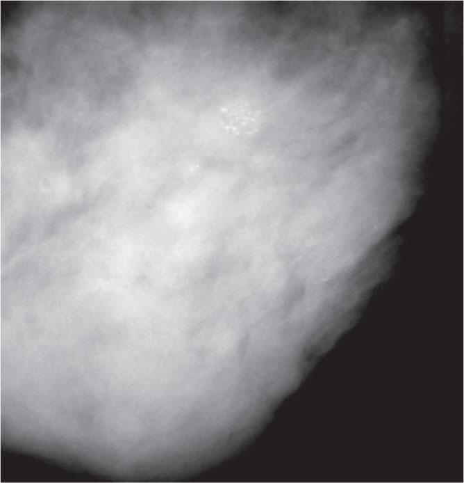 Crushed stone-like microcalcifications (pleomorphic).