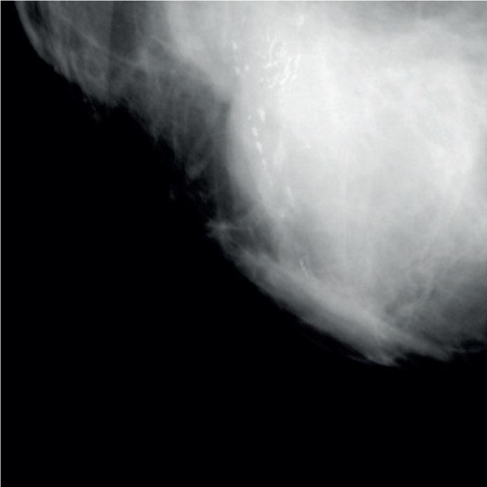 Casting-type microcalcifications (linear, branching).