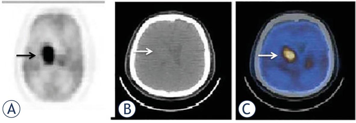 There was a mass in antrum of stomach on transaxial CT (A), PET (B), fusion (C) and MIP images (D) (arrows) of a 60-year old female patient with primary gastric lymphoma of DLBC type. She had metabolic tumor parameters of SUVmax: 11, SUVmean: 5, MTV:34 cm3, TLG:150. Her outcome was excellent with a DFS and OS of 111 months.
