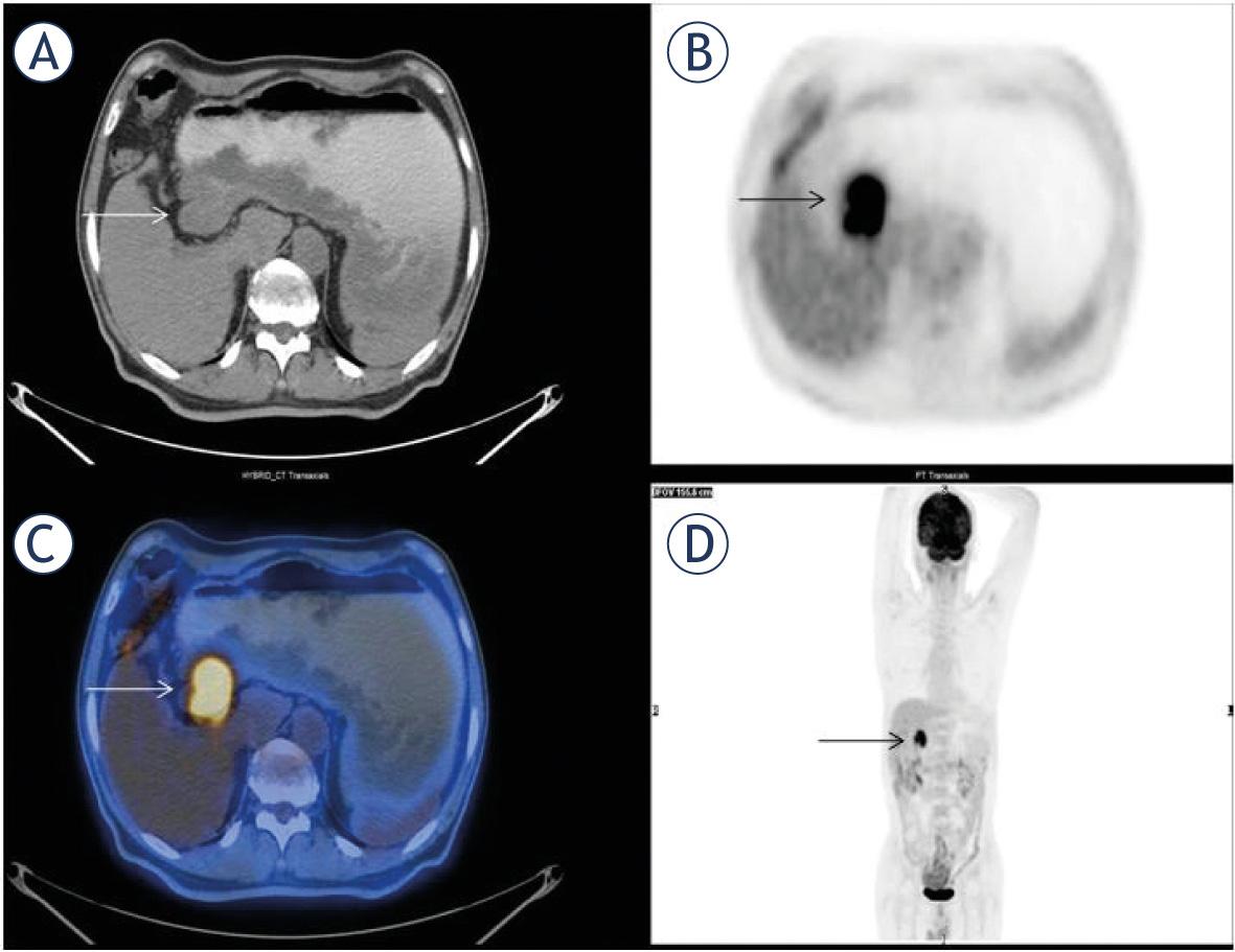 61-year old female patient was diagnosed with primary CNS lymphoma of DLBC type. There was a mass in right periventricular region adjacent to right thalamus on transaxial PET (A), CT (B) and fusion (C) images (arrows). She was in serious risk because of her high metabolic tumor parameters (SUVmax: 35, SUVmean: 25, MTV: 425 cm3, TLG: 2543) and died of the disease 11 months after the diagnosis.