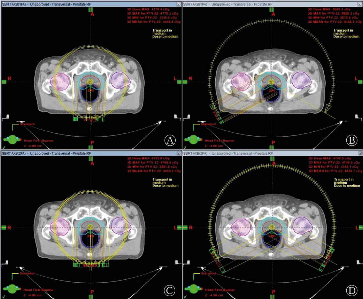An arrangement of (A) one full arc (1FA), (B) one partial arc (1PA), (C) two full arcs (2FA), and (D) two partial arcs (2PA) in prostate SBRT-VMAT for the same patient.