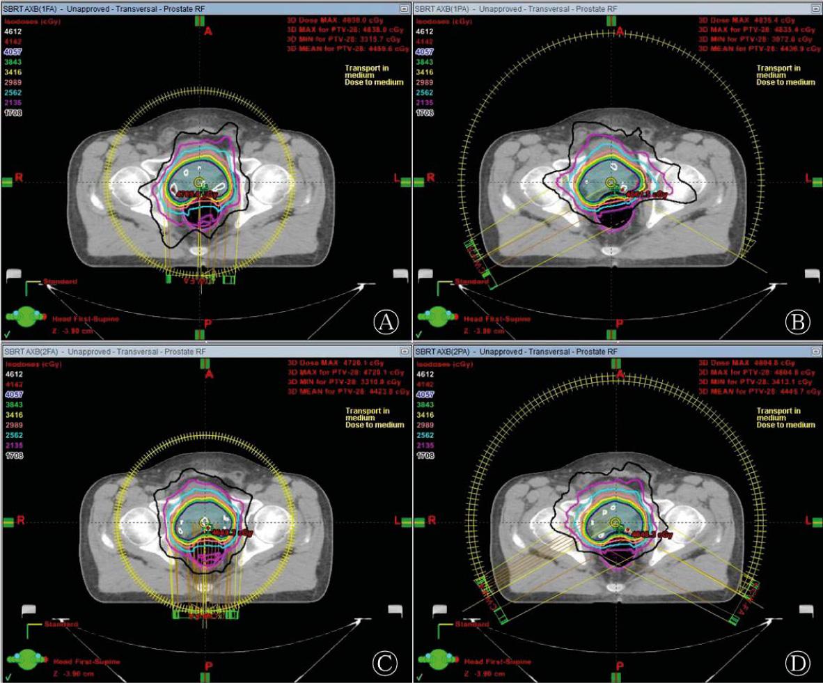 An example of the dose distributions achieved with (A) one full arc (1FA), (B) one partial arc (1PA), (C) two full arcs (2FA), and (D) two partial arcs (2PA) arrangement in prostate SBRT-VMAT for the same patient.