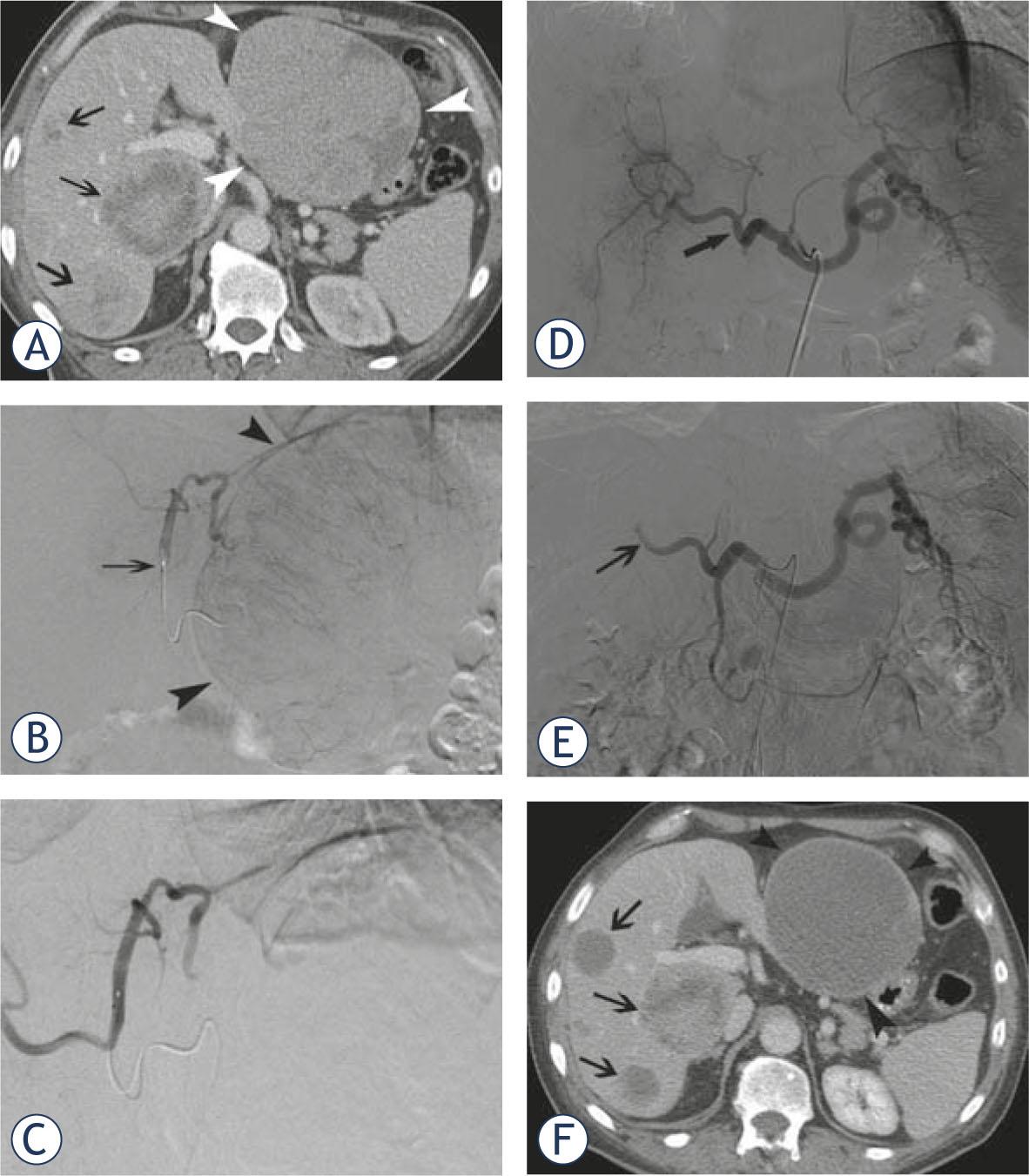 A 63-year-old male patient presented with a carcinoid of the lung and diffuse bilobar liver involvement. (A) Portal venous phase contrast-enhanced CT-scan confirms diffuse metastatic involvement of both liver lobes (white arrowheads at the level of the largest metastasis in the left liver lobe; black arrows at the level of multiple smaller lesions in the right liver lobe); Selective angiogram of the left hepatic artery (B) before and (C) after chemoembolization with doxorubicin-eluting SAP-microspheres (arrow at the level of the micro-catheter in the left hepatic artery); Selective angiogram of the celiac trunk (D) before and (E) after chemoembolization with doxorubicin-eluting SAP-microspheres (arrow shows stasis of contrast at the level of the right hepatic artery); (F) Portal venous phase contrast-enhanced CT-scan 10 weeks after initial chemoembolization shows marked decrease in volume and enhancement of most of the metastatic lesions in left and right liver lobes.