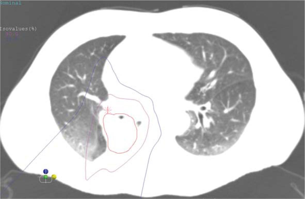 Dose distribution map of proton beam therapy for central lung cancer. The red line represents the gross tumor volume and the purple line around the tumor represents the 90% dose line. The region outside the outermost blue line is allocated to < 10% radiation.
