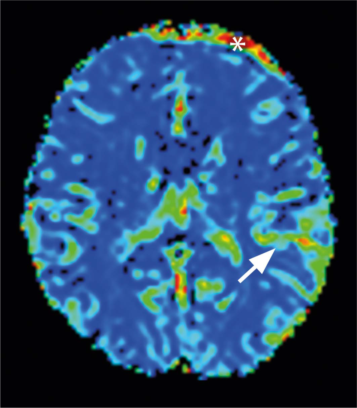 increased blood flow (arrow) in the region of the left medial cerebral artery; signal changes adjacent to left frontal bone (asterix) are the artefact (patient 15)