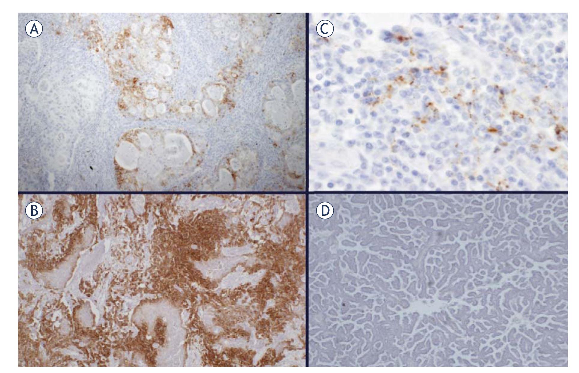PD-L1 expression in NSCLC. Positive membranous reaction in tumor cells in adenocarcinoma (A), and squamous-cell carcinoma (B), positive cytoplasmic reaction in immune cells (C), negative reaction in adenocarcinoma (D).