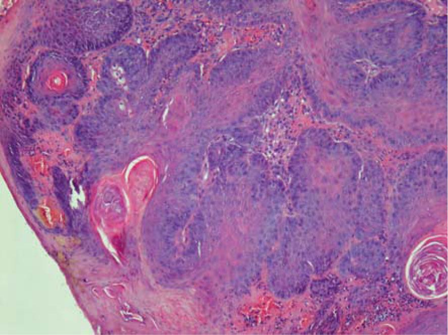 Histological presentation of squamous papilloma (Tumour 4). Hematoxylin and eosin stain, 100 x.