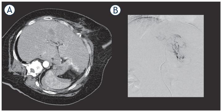 68-year-old female patient with active bleeding (A) on the dorsal side of the left lobe of the liver (*) immediately after RFA and perisplenic hematoma (#). Diagnostic angiography (B) immediately after the RFA did not show any active arterial bleeding. The patient was then monitored on a normal ward, and the bleeding ceased without further intervention.