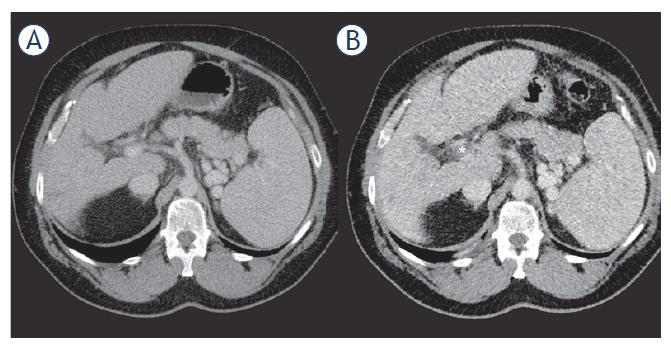 57-year-old male patient with partial thrombosis (*) of the main portal vein one day after microwave ablation (B). (A) Pre-interventional CT scan without visible thrombosis. Anticoagulation led to the regression of thrombosis without any necessary intervention.