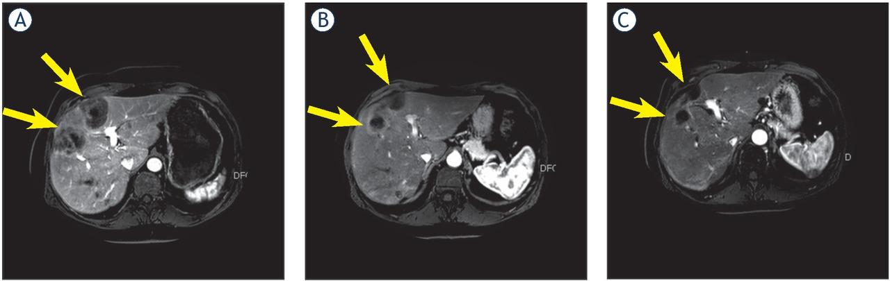Hepatic response on magnetic resonance imaging (MRI) before 90Y treatment (A), after 90Y treatment (B) and after 2 cycles of MMC infusion (C). C is a partial response relative to A. Arrows indicate the liver metastases.