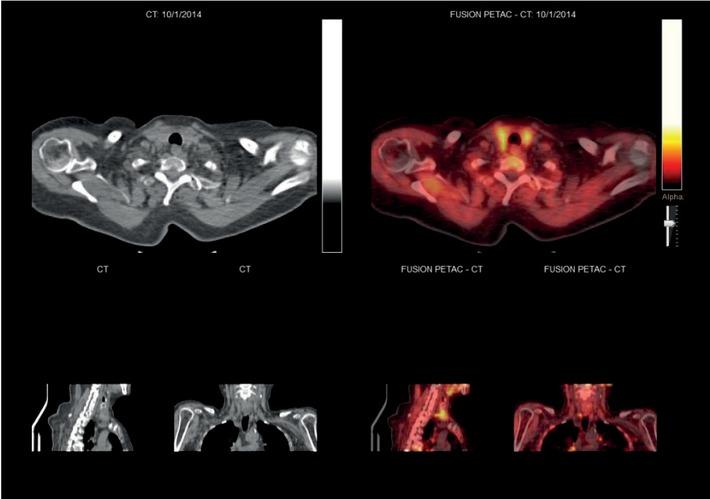 18F-fluorocholine (FCH) PET-CT fusion images of patient with pathologic uptake in the right lower parathyroid gland (solitary adenoma).