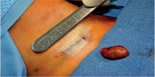 Directed parathyroidectomy. The image shows the incision site and the removed parathyroid tissue.