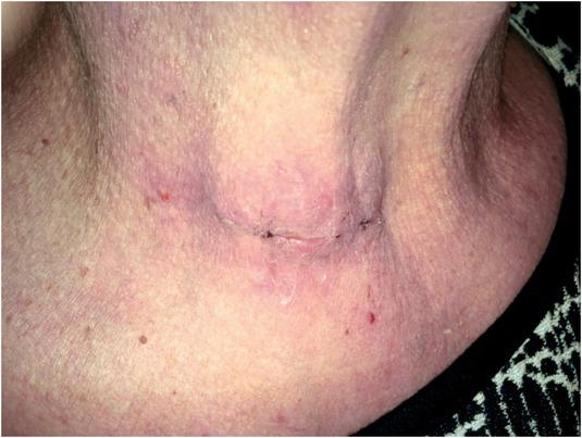 Appearance of the incision and surrounding skin 10 days after performing directed parathyroidectomy.
