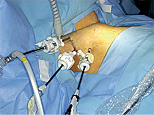 Total endoscopic parathyroidectomy.