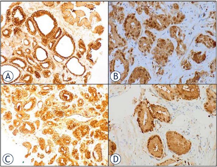 Immunohistochemistry of nuclear factor-kappa beta (NF-κB) p65. (A) Positive cytoplasmic staining (GS 6). (B) Positive nuclear staining. (C) Positive cytoplasmic staining (GS 7). (D) Positive nuclear staining.