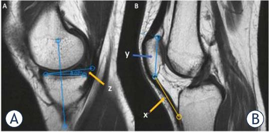 (A, B) Sagittal T1-Weighted MR images illustrating medial tibial slope and Insall-Salvati index. (Medial tibial slope, z: the angle formed between the line running along the tibial slope of the medial tibial condyle and the perpendicular line to the tibial axis; Insall-Salvati index: the ratio of x to y; x, the length of patellar tendon and y, the greatest diagonal length of patella)