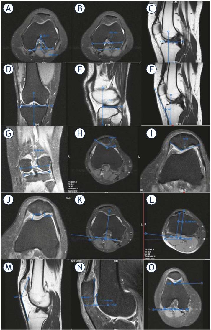 Measurements of nonsignificant MRI parameters in the final model. (A) Axial MRI plane of the knee showing Intercondylar notch angle (INA) and Intercondylar depth (ID): The posterior bicondylar line is drawn. ID is the distance between top of the notch to the bi-epicondylar line. Intercondylar notch angle is defined as the angle formed by the 2 lines going from the top of the notch to the most inferior aspect of the notch at the medial and lateral condyles; (B) Axial MRI plane of the knee showing Intercondylar Width (IW), Medial condyle width (MCW), and Lateral condyle width (LCW): IW is the distance between the medial and lateral femoral condyle walls at the anterior third of the intercondylar depth (the middle line), the other two distances in this axial cut represent LCW, and MCW; (C) Sagittal MRI plane of the knee showing anterior tibial slope (ATS): At first the tibial axis is drawn by joining to midpoints between the anterior and posterior cortex of the tibial diaphysis with at least 5cm distance from each other. The anterior tibial slope is then defined as the angle between a perpendicular line (inferior line) to the longitudinal axis and a line passing through the anterior cruciate ligament tibial footprint (superior line); (D) Sagittal MRI plane of the knee showing coronal tibial slope (CTS): The coronal tibial slope is defined as the angle between a line joining the highest points on the medial and lateral aspects of the tibial plateau (inferior horizontal line) and a perpendicular line (superior horizontal white line) to the longitudinal axis as mentioned above; (E) Sagittal MRI plane of the knee showing lateral tibial slope (LTS): the angle formed between the line running along the tibial slope of the medial tibial condyle and the perpendicular line to the tibial axis; (F) Sagittal MRI plane of the knee showing patellar tibial tendon shaft angle (PTTS angle): PTTS angle is measured as the angle between Proximal tibial anatomical axis described above and patellar tendon axis in the mid-sagittal section; (G) Coronal MRI plane of the knee showing notch width index (NWI): first Bicondylar width parallel to the joint line at the level of popliteal groove is measured (1). Then notch width is measured at the level of popliteal groove, using the line joining the innermost margins of the femoral condyles at the borders of the intercondylar notch (2). The NWI is ratio of 2/1; (H) Axial MRI plane of the knee showing sulcus angle (SA): The angle formed between the medial and lateral trochlear facets; (I) Axial MRI plane of the knee showing patellar facet angle (PFA): the angle between two line connecting the central ridge to the middle of patellar facets; (J) Axial MRI plane of the knee showing patellofemoral index (PFI): the ratio of medial to lateral interspaces; (K, L) Axial MRI plane of the knee showing tibial tuberosity trochlear groove distance (TTTG): posterior line was drawn at posterior border of femoral condyles. A vertical line is drawn at trochlear groove and the other parallel line is drawn along the tibial tuberosity that transferred to this level. Distance between the two lines is measured as TT-TG; (M) Sagittal MRI plane of the knee showing Patella-patellar tendon angle (P-PT angle): The P–PT angle was defined as the angle between the upper patellar pole and the lower patellar pole, and the tibial tuberosity; (N) Sagittal MRI plane of the knee showing Patellotrochlear index (PTI): it is defined as the length of patellar cartilage overlapping the trochlear cartilage divided by length of patellar cartilage; (O) Axial MRI plane of the knee showing medial trochlear inclination (MTI): the angle formed between the medial trochlear facet and a parallel line to the line connecting the posterior-most cortical surfaces of the femoral condyles.