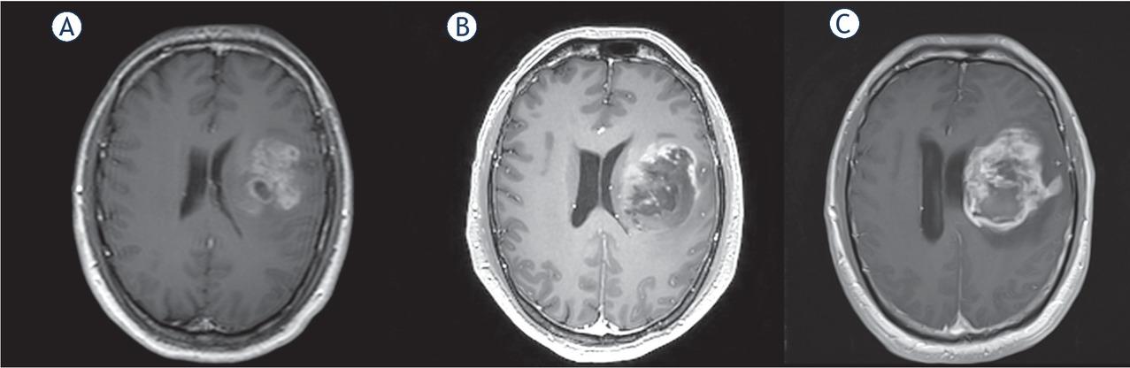 MRI scans in Patient 2 at 0 (A), 18 (B) and 54 (C) days. (T1 with gadolinium sequences).