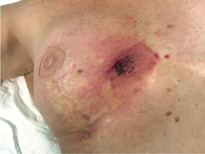 Clinical presentation of patient with angiosarcoma of right reconstructed breast.