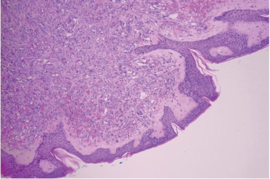 Pathologic hematoxylin and eosin (HE) specimen showing radiotherapy-associated angiosarcoma (RAA) involving dermis.