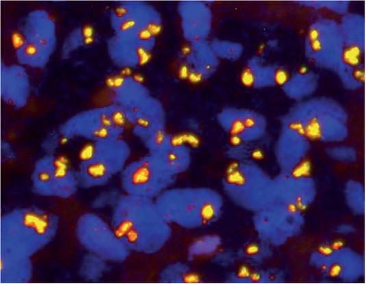 Amplification of the MYC oncogene was confirmed using FISH method on tumor specimen.