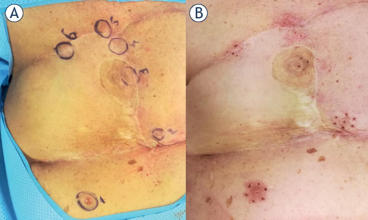 Treatment with electrochemotherapy. (A) Just before the treatment nodules were marked for evaluation; (B) 1 month after the treatment all nodules were in complete response.