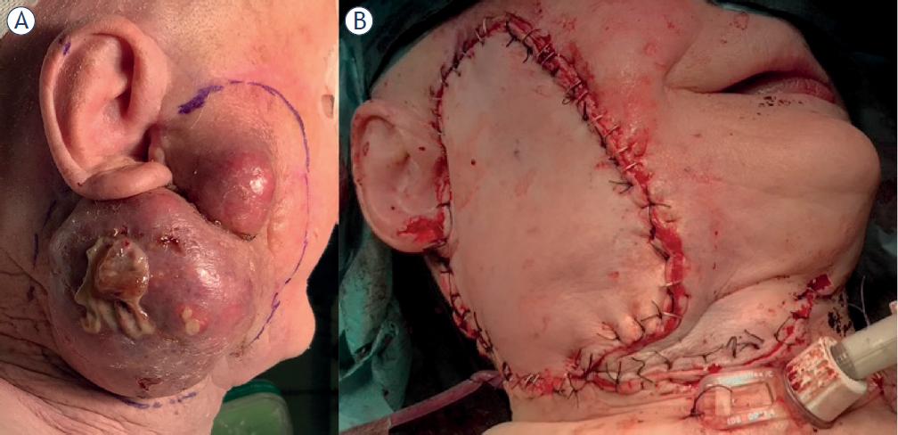 85-year old female with locoregionally advanced parotid adenocarcinoma (i.e., parotid metastasis after incomplete temporal skin adenocarcinoma cancer resection) extending to the right external auditory canal and lateral skull-base. The resection margin is outlined (A). Primary surgery involving mastoidectomy with wide local excision, total parotidectomy, modified radical neck dissection, temporary tracheostomy, static suspension of oral commissure with fascia lata and anterolateral thigh free flap reconstruction were performed (B).