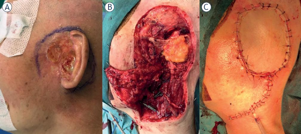 73-year old female with locoregionally advanced external ear basal cell carcinoma extending to the left lateral skull-base. The resection margin is outlined (A). Salvage surgery (i.e., after primary radical radiotherapy and electrochemotherapy) involving lateral temporal bone resection with fat obliteration, with wide local excision, partial parotidectomy, ipsilateral selective neck dissection (B) and radial forearm free flap reconstruction (C) were performed.