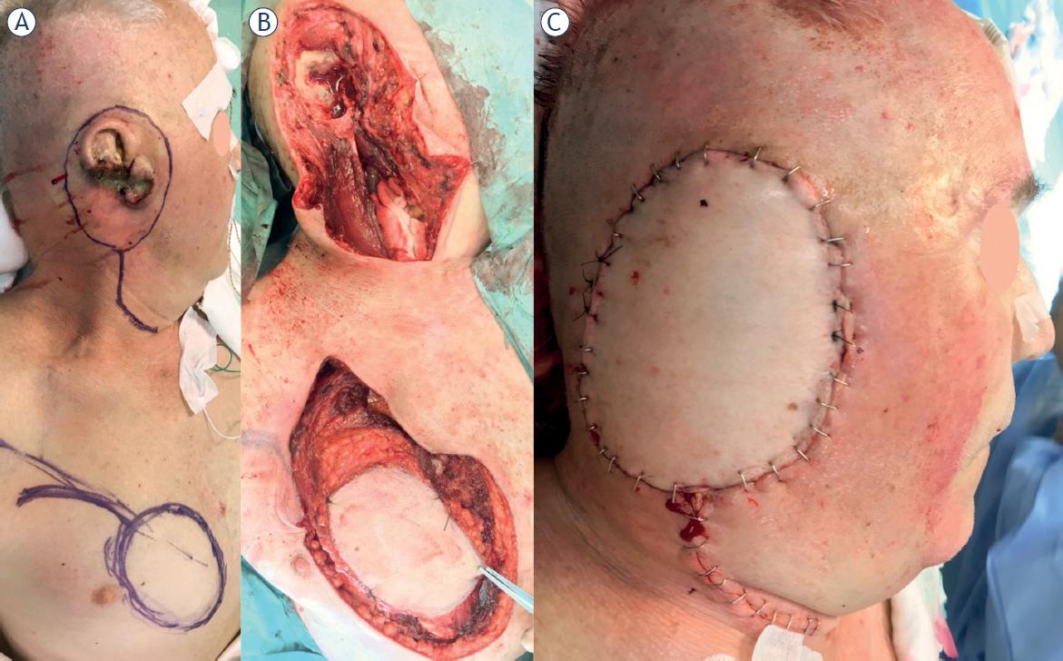 76-year old male with locoregionally advanced external ear squamous cell carcinoma extending to the right lateral skull-base. The resection margin is outlined (A). Salvage surgery (i.e., after primary radical radiotherapy) involving lateral temporal bone resection with wide local excision, partial parotidectomy, ipsilateral selective neck dissection and pectoralis major myocutaneous flap reconstruction (due to recipient vessel insufficiency) were performed (B, C).