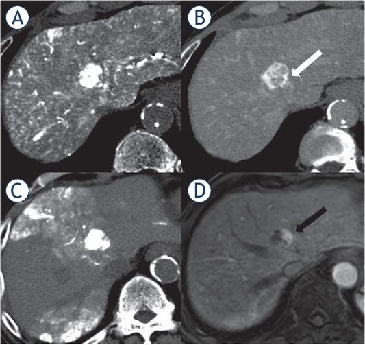 Local tumor recurrence after transcatheter arterial chemoembolization (TACE) in an 82-year-old patient with a hepatocellular carcinoma. (A) Early-phase computed tomography during hepatic arteriography (CTHA) demonstrated a hypervascular nodule in S5. (B) Late-phase CTHA demonstrated the corona enhancement around the tumor (white arrow). (C) Non-contrast-enhanced computed tomography performed immediately after TACE showed dense accumulation of iodized oil throughout the tumor, but not in the entire corona enhancement area. (D) In contrast enhanced magnetic resonance images obtained 4 months after TACE, local recurrence developed around the tumor (black arrow).