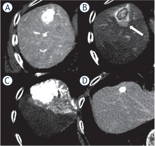 Complete response after transcatheter arterial chemoembolization (TACE) in a 77-year-old patient with a hepatocellular carcinoma. (A) Early-phase computed tomography during hepatic arteriography (CTHA) demonstrated a hypervacular nodule in S4. (B) Late-phase CTHA demonstrated the corona enhancement around the tumor (white arrow). (C) Non-contrast-enhanced computed tomography performed immediately after TACE showed dense accumulation of iodized oil beyond corona enhancement area. (D) Contrast-enhanced computed tomography performed 15 months after TACE showed no enhancement around the tumor.