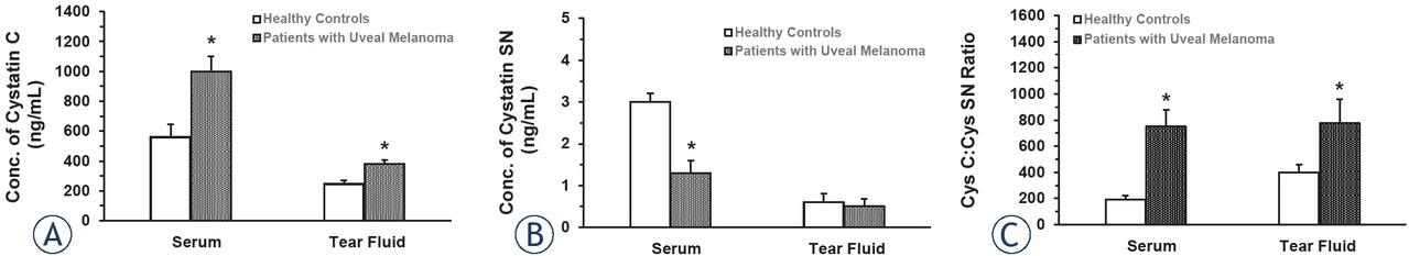 Cystatin C (A) and cystatin SN (B) concentrations and their ratio (C) in the serum and tear fluid of patients with uveal melanoma. (A) Values represent the mean ± standard deviation (s.d.) of n = 15 healthy controls (mean age = 53.1 ± 3.4 years) and n = 51 of 57 total patients with uveal melanoma (mean age = 51.7 ± 2.8 years; 6 patients were > 60 years old and were therefore not included). (B) Values represent the mean ± s.d. of n = 15 healthy controls (mean age = 53.1 ± 3.4 years) and n = 51 of 57 total patients with uveal melanoma (mean age = 51.7 ± 2.8 years; 6 patients were > 60 years old and were therefore not included). (C) Values represent the mean ± s.d. of n = 15 healthy controls (mean age = 53.1 ± 3.4 years) and n = 51 of 57 total patients with uveal melanoma (mean age = 51.7 ± 2.8 years; 6 patients were > 60 years old and were therefore not included).
* = significant difference (p < 0.001) from the mean value for healthy controls in each biological matrix