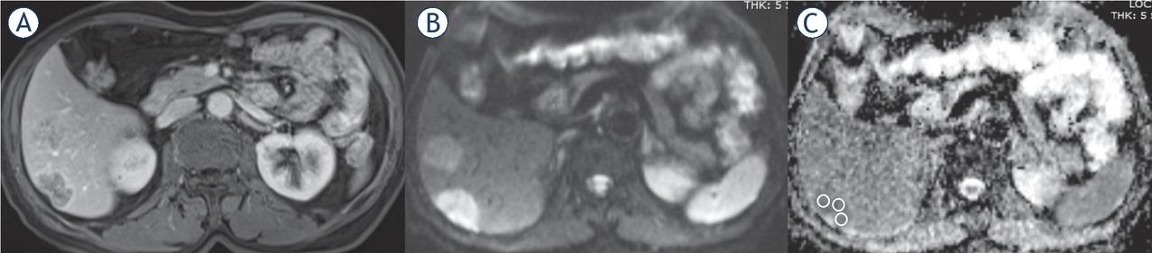 59-year-old male with liver metastases due to colorectal adenocarcinoma. Contrast-enhanced axial T1-weighted (T1W) (A), diffusion weighted image (DWI) obtained at b value of 800 s/mm2 (B) and apparent diffusion coefficient (ADC) maps (C) with free hand ROI placement technique.