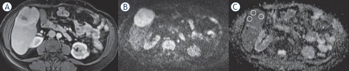 58-year-old female with an expansile liver mass with central hypovascular fibrous stroma and peripheral contrast enhancement on contrastenhanced axial T1-weighted (T1W) (A) images. diffusion weighted image (DWI) obtained at b value of 800 s/mm2 (B) and apparent diffusion coefficient (ADC) maps (C) with region of interests (ROI) placement with three different contrast enhancing area for calculating ADCmean values.