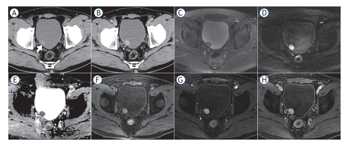 CT and MR images of a 61-year-old male patient with bladder paraganglioma. The tumour was located in the posterior bladder wall, oval, well-defined margin, protruding into the bladder cavity with broad-base attachment to the bladder wall (short arrow). The lesion showed slight hypodensity and obvious enhancement on axial pre- and post-contrast-enhanced CT images (A, B), homogenous slight hyperintensity on T2-weighted images (T2WI) (C), marked hyperintensity on diffusion-weighted images (DWI) (D), hypointensity on apparent diffusion coefficient (ADC) maps (mean ADC value, 0.870 × 10-3 mm2/s) (E), hyperintensity compared to the gluteus maximus on T1-weighted images (T1WI) (F) and “fast in and slow out” on dynamic contrast-enhanced MRI (G, H).