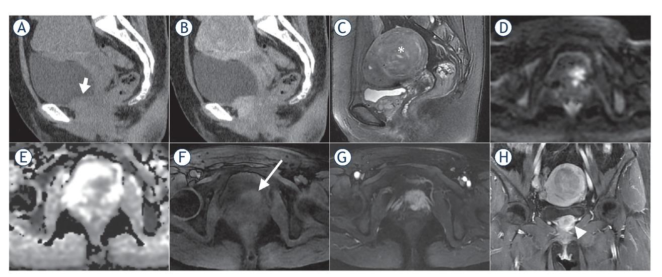 CT and MR images of a 47-year-old female with malignant bladder paraganglioma. The bladder tumour was located in the inferior bladder wall with an irregular shape and ill-defined margin, invading the adjacent tissues (short arrow). The tumour showed iso-density and moderate enhancement on sagittal pre- and post-contrast enhanced CT images (A, B), inhomogenous hyperintensity on sagittal T2-weighted images (T2WI) (C), hyperintensity on diffusion-weighted images (DWI) (D), hypointensity on apparent diffusion coefficient (ADC) maps (mean ADC value, 0.852 × 10-3 mm2/s) (E), inhomogenous slight hyperintensity compared to the gluteus maximus on T1-weighted images (T1WI) (long arrow) (F), heterogenous marked enhancement on arterial phase (G) and coronal contrast-enhanced images (arrowhead) (H). In addition, a uterine fibroid on the posterior wall of the uterus was also found (asterisk on sagittal T2WI).