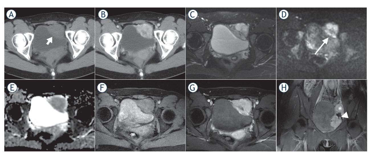 CT and MR images of a 25-year-old female with malignant bladder paraganglioma. The tumour was located in the left bladder wall with irregular shape, presenting heterogenous hypodensity (short arrow) and obvious enhancement on axial pre- and post-contrast enhanced CT images (A, B), heterogenous slight or marked hyperintensity on T2-weighted images (T2WI) (C), heterogenous hyperintensity on diffusion-weighted images (DWI) (long arrow) (D), hypointensity on apparent diffusion coefficient (ADC) maps (mean ADC value, 0.997×10-3 mm2/s) (E), slight hyperintensity compared to the gluteus maximus on T1WI (F) and early marked enhancement on arterial phase images (G). Coronal enhanced MRI showed the lesion encased the left iliac artery branch (arrowhead); a similar enhanced lesion was located next to the left iliac vessels (asterisk), suggesting multiple paraganglioma (H).