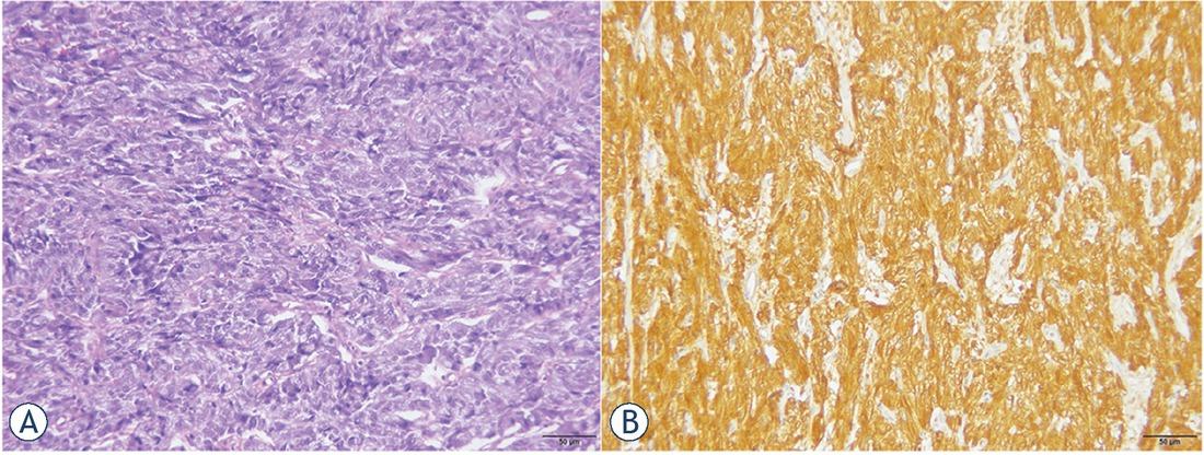 Microscopic examination of paraganglioma. (A) Polygonal or oval tumour cells were rich in basophil granular cytoplasm and arranged in a sheet or organoid arrangement. (Hema toxylin and eosin staining, × 400). (B) Immunohistochemical staining of tumours cells was positive for chromogranin A (CgA) (EnVision × 200).