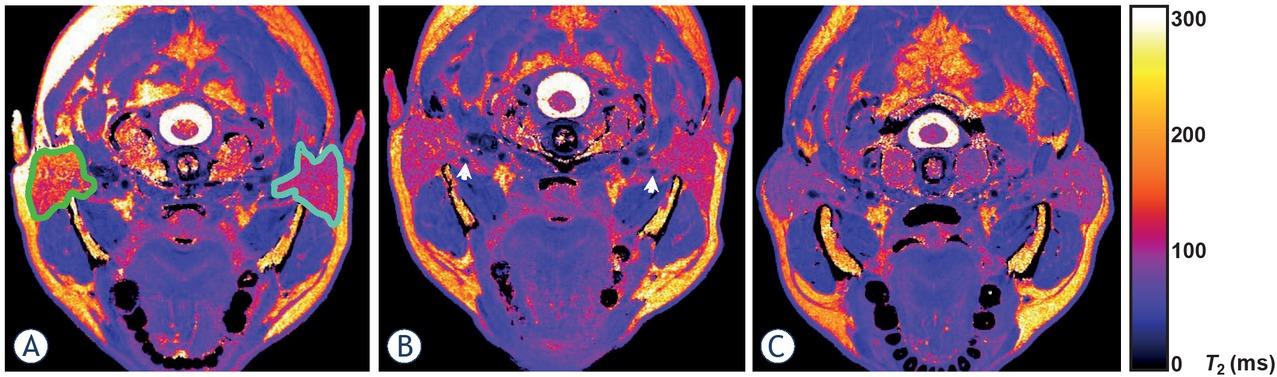 Representative T2 maps of parotid glands in a single transversal slice in a patient following radiotherapy for head and neck tumour before (A) and after hyperbaric oxygenation therapy (HBOT) (B) and in healthy control (C). Region of interest (ROI) on the ipsilateral side is encircled by green and on the contralateral side by the white-blue colour. Retromandibular veins (white arrows in B) were always carefully omitted from the ROI.