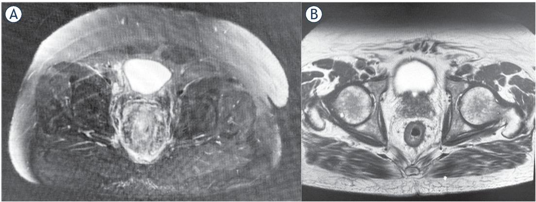 (A) NMR imaging before Electrochemotherapy (ECT) and (B) follow-up evaluation 4 weeks after the ECT session.