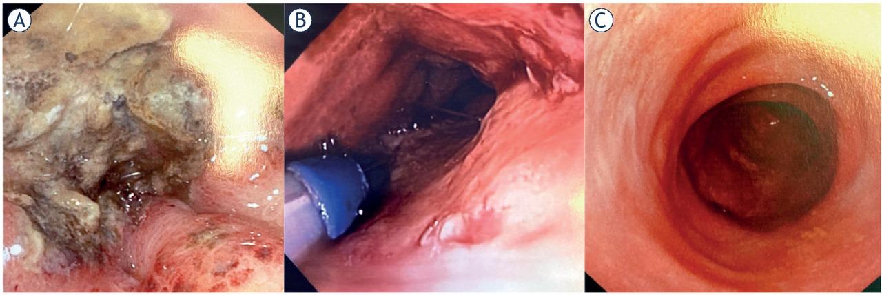 Electrochemotherapy (ECT) session. (A) before ECT, (B) electrode positioning, (C) at the 4-week follow-up.