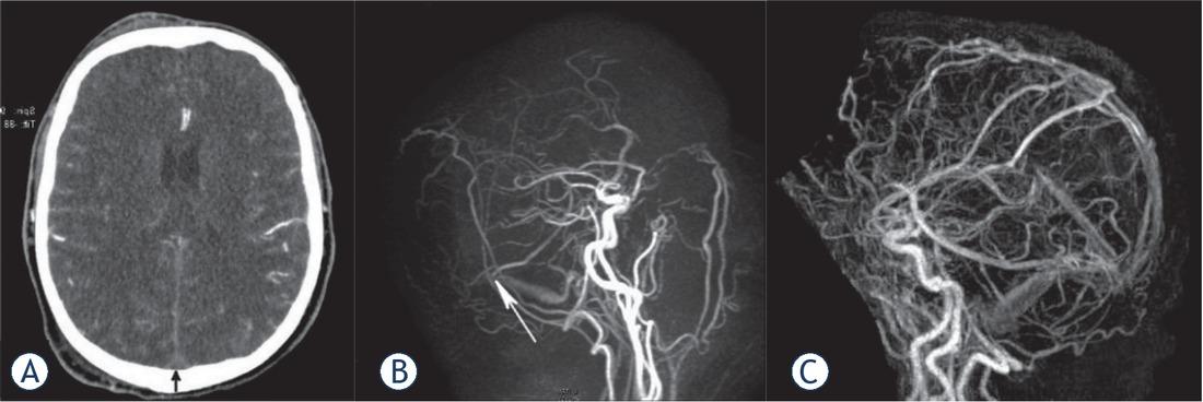 A 59-year old man was examined after 5 days of headaches and a seizure. CT revealed bilateral cortical subarachnoid hemorrhage (SAH) and moderate diffuse brain edema, but no hemorrhagic infarction was formed (A). An extensive thrombosis of cerebral sinuses/veins including the superior sagittal sinus, transversal sinuses, left sigmoid sinus and jugular bulb was observed. The right transversal sinus was occluded to the point of Labbe vein inflow (B), arrow showing confluence of vein to sinus). Fractured heparin and later warfarin were introduced; the patient scored 0 according modified Rankin Score (mRs) at control examination. Complete recanalization of the occluded sinuses occurred (C).