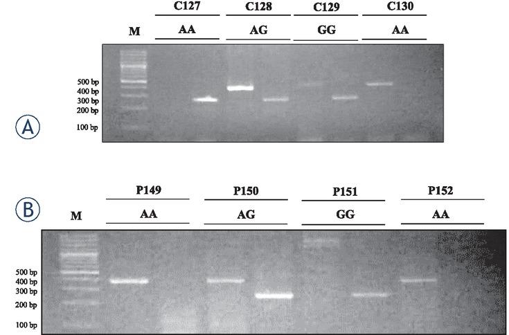 Akt rs1130233 single nucleotide polymorphism in (A) Control and (B) colorectal cancer patients. Representative images have been shown. AA genotype (379 bp band); AG genotype (245 and 379 bp bands); GG genotype (245 bp band). The number above the lanes indicate subjects identity.C = Control, P = CRC Patient, M = DNA Marker