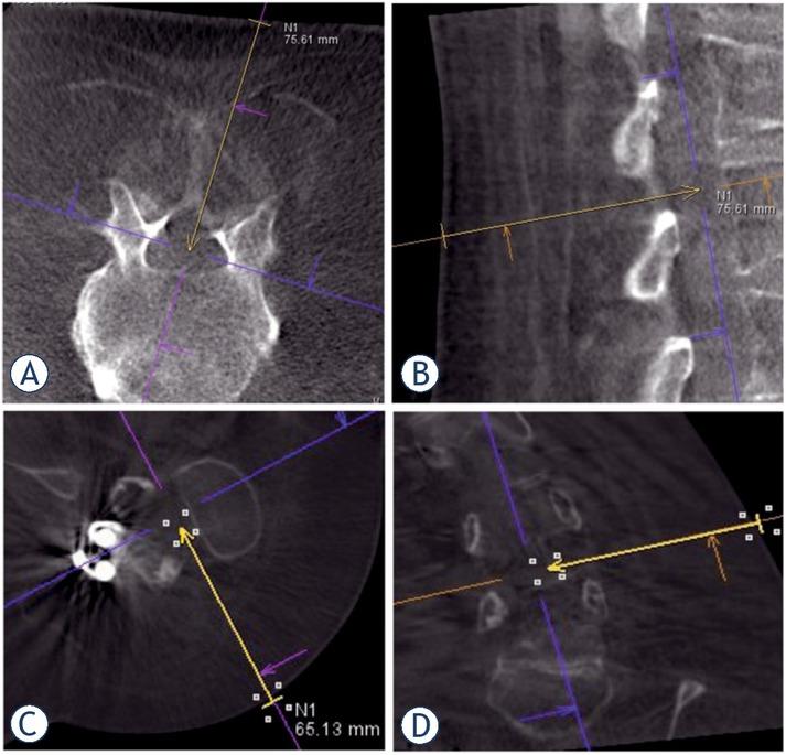 Cone-beam CT orthogonal reconstructions demonstrating the planned needle trajectory. (A), (B). Planning the interlaminar approach (yellow arrows); (C), (D). Planning the transforaminal approach (yellow arrows).