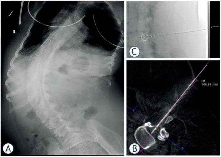 (A). A 22-year-old female with severe scoliotic deformity of the spine; (B). The nusinersen administration was performed with interlaminar approach under cone-beam CT -guidance; (C). Introduction of the needle following the planned trajectory (white dotted line) to the target point (white circle).