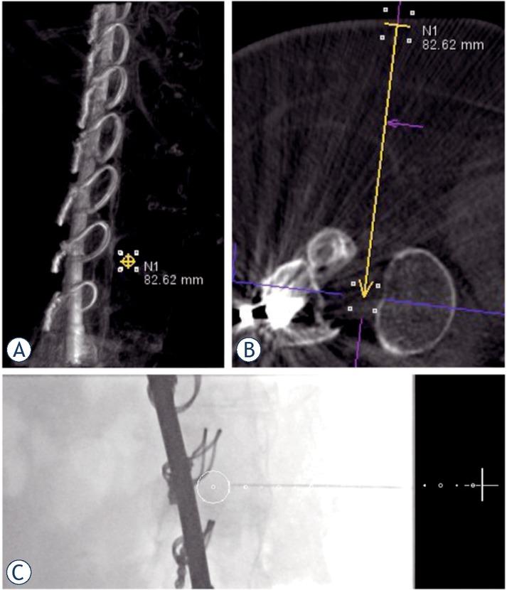(A). A 42-year old female after corrective surgery for scoliosis; (B). Transforaminal approach planning before needle introduction (yellow arrow); (C). Introduction of the needle following the planned trajectory (white dotted line) to the target position (white circle).
